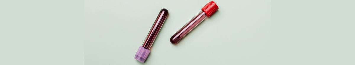 Riduzione delle attività di prelievo di sangue l’11 maggio 2022 nell’unità operativa di Patologia clinica dell’ospedale di Chieti
