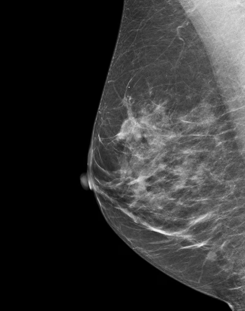 Mammografia con mezzo di contrasto a Ortona